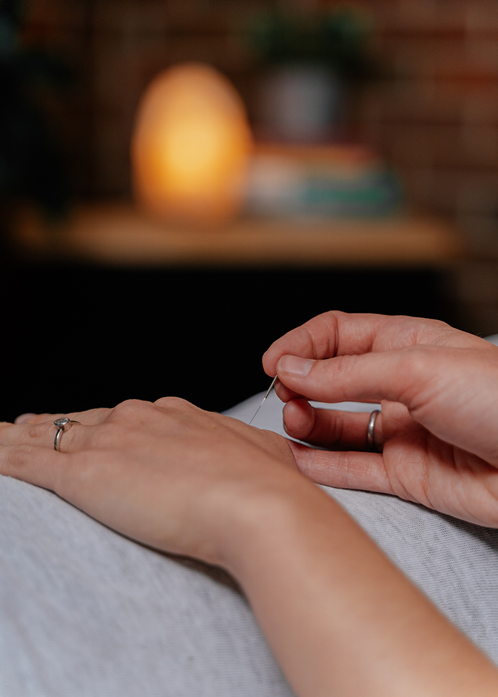 Acupuncture on Hand